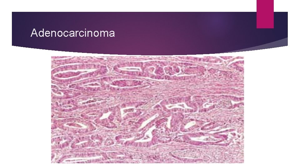 Adenocarcinoma 