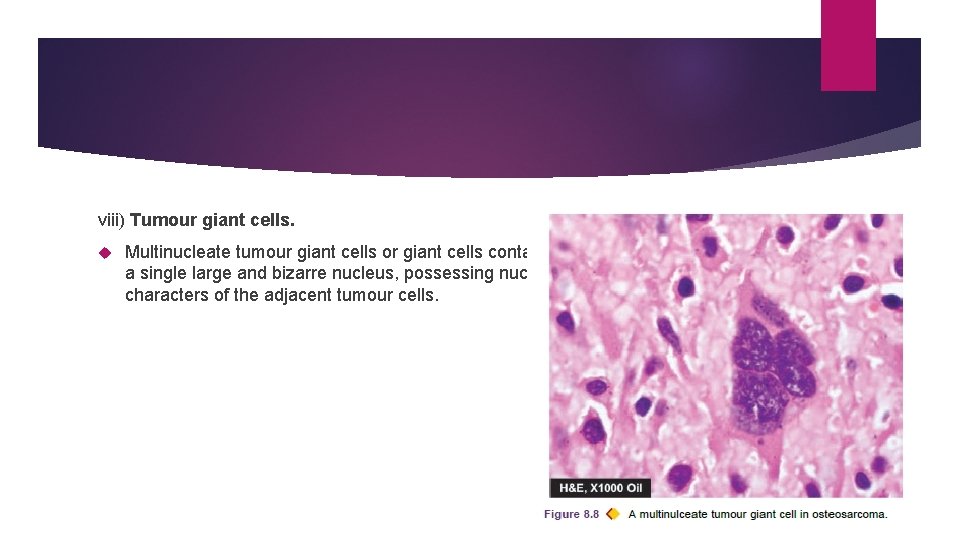 viii) Tumour giant cells. Multinucleate tumour giant cells or giant cells containing a single