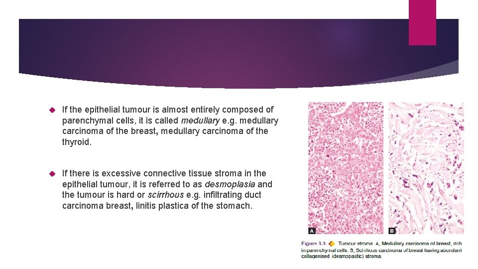  If the epithelial tumour is almost entirely composed of parenchymal cells, it is