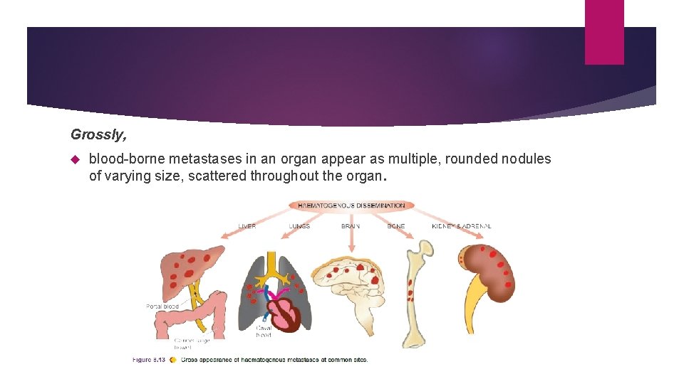 Grossly, blood-borne metastases in an organ appear as multiple, rounded nodules of varying size,