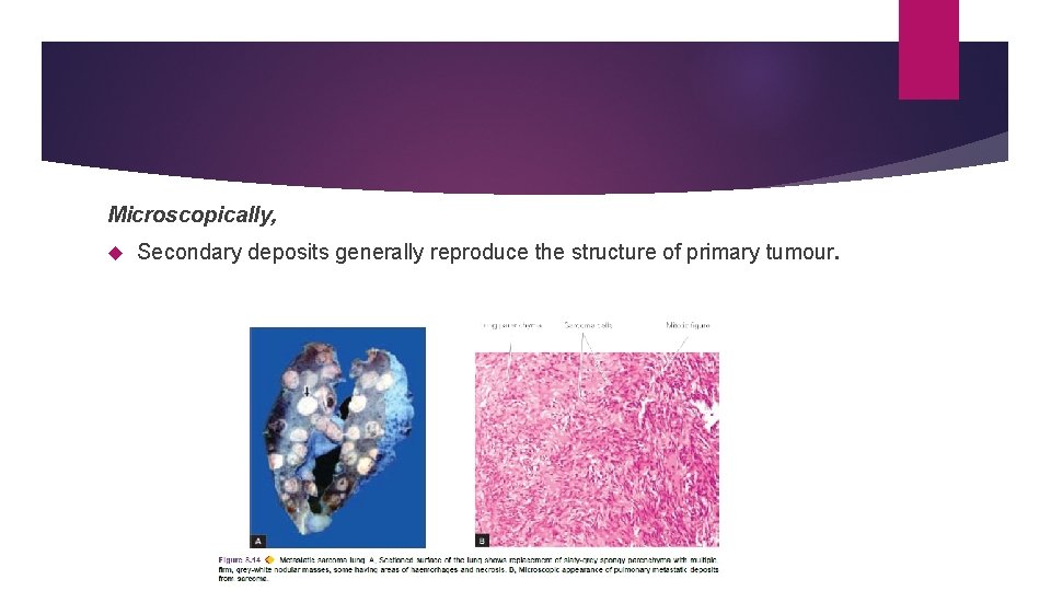 Microscopically, Secondary deposits generally reproduce the structure of primary tumour. 