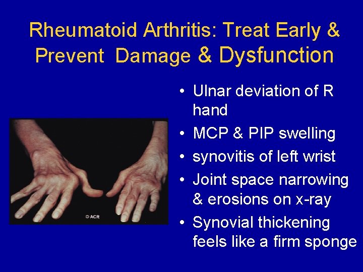 Rheumatoid Arthritis: Treat Early & Prevent Damage & Dysfunction • Ulnar deviation of R