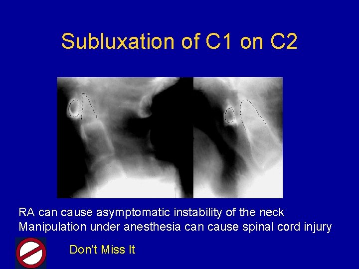 Subluxation of C 1 on C 2 RA can cause asymptomatic instability of the