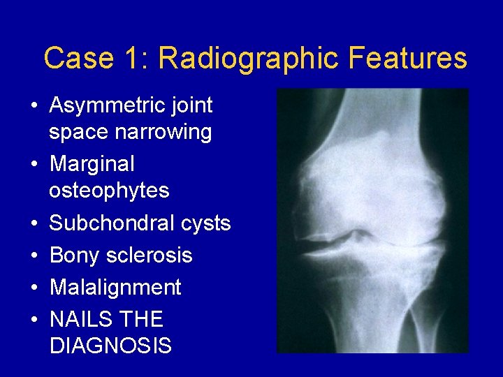 Case 1: Radiographic Features • Asymmetric joint space narrowing • Marginal osteophytes • Subchondral