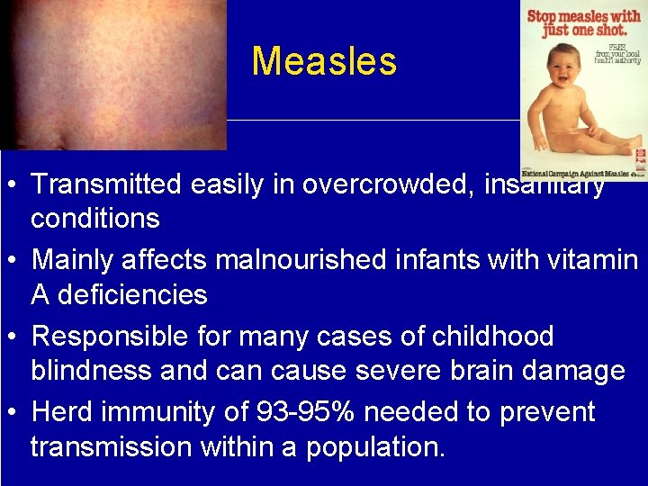 Measles • Transmitted easily in overcrowded, insanitary conditions • Mainly affects malnourished infants with