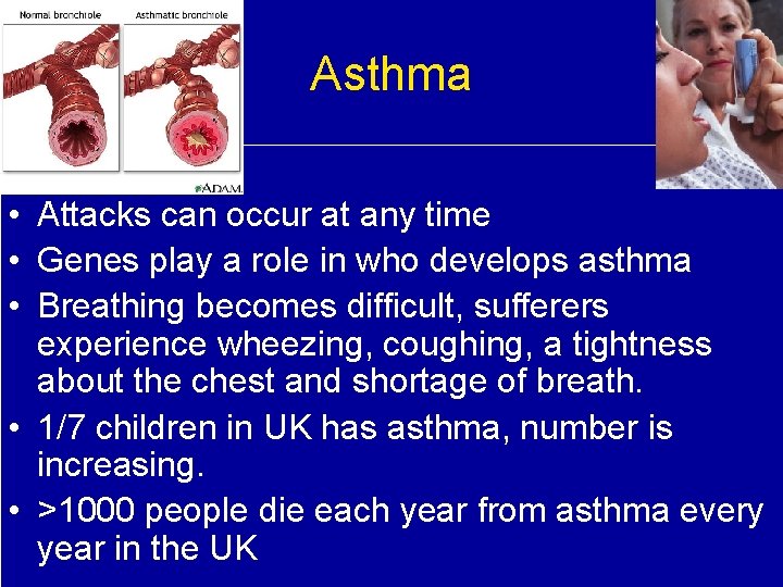 Asthma • Attacks can occur at any time • Genes play a role in