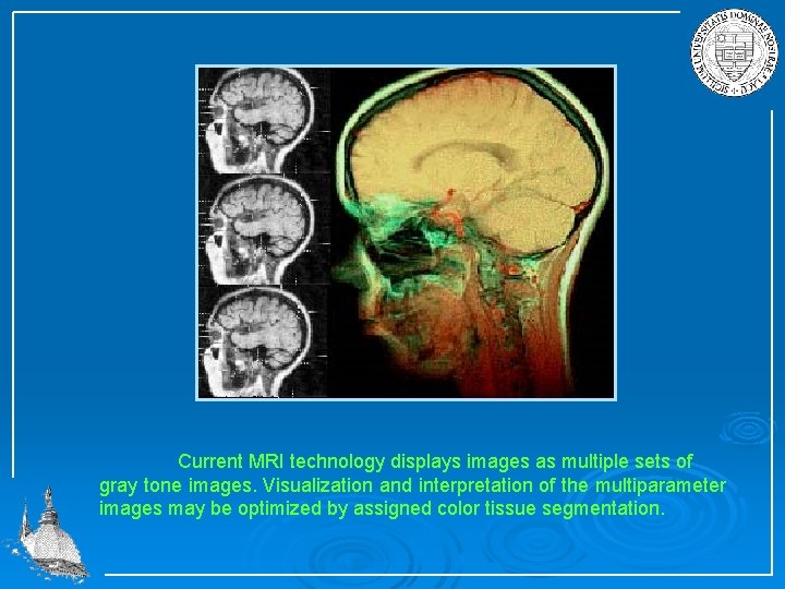 Current MRI technology displays images as multiple sets of gray tone images. Visualization and