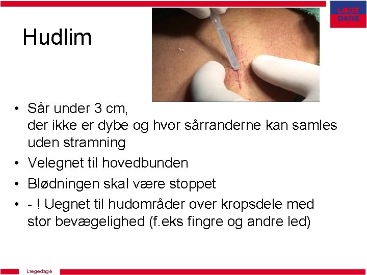 Hudlim • Sår under 3 cm, der ikke er dybe og hvor sårranderne kan