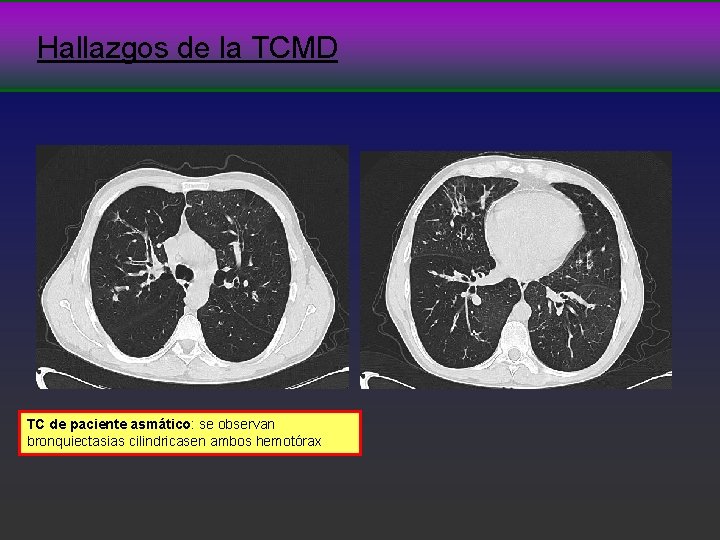 Hallazgos de la TCMD TC de paciente asmático: se observan bronquiectasias cilindricasen ambos hemotórax