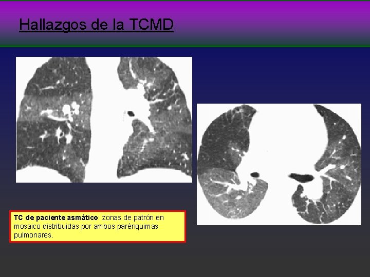Hallazgos de la TCMD TC de paciente asmático: zonas de patrón en mosaico distribuidas