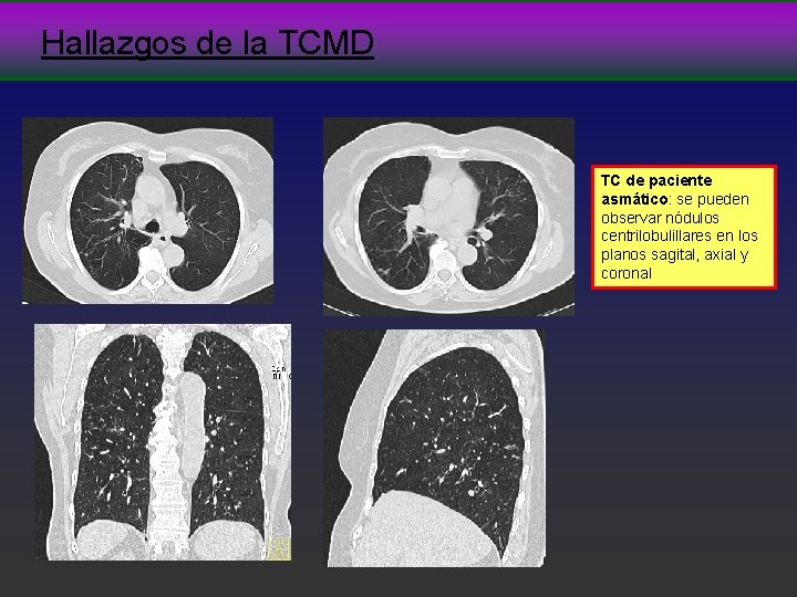 Hallazgos de la TCMD TC de paciente asmático: se pueden observar nódulos centrilobulillares en