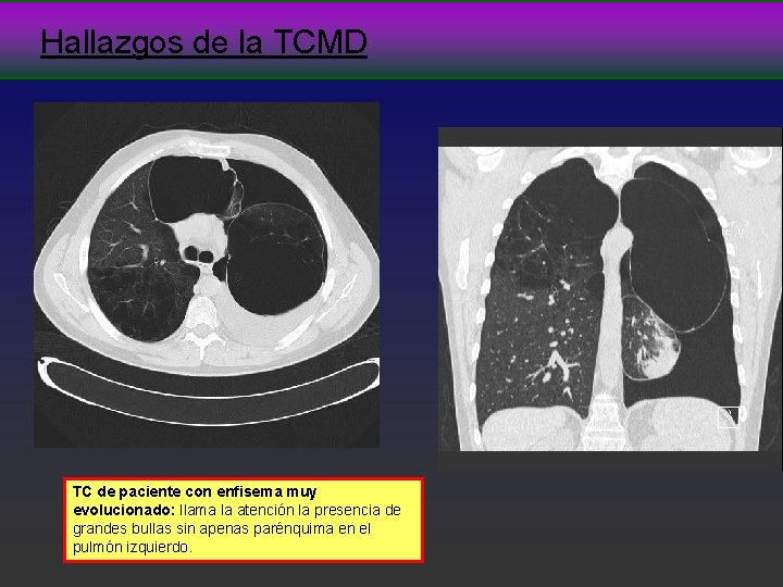 Hallazgos de la TCMD TC de paciente con enfisema muy evolucionado: llama la atención