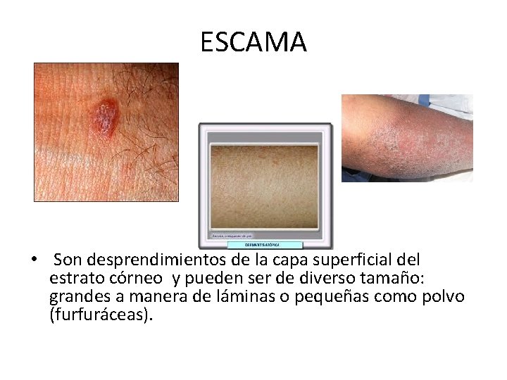 ESCAMA • Son desprendimientos de la capa superficial del estrato córneo y pueden ser