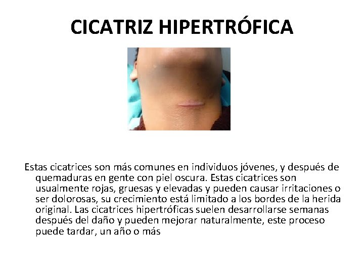 CICATRIZ HIPERTRÓFICA Estas cicatrices son más comunes en individuos jóvenes, y después de quemaduras