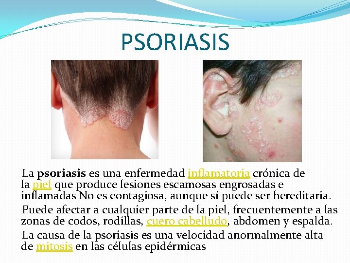 PSORIASIS La psoriasis es una enfermedad inflamatoria crónica de la piel que produce lesiones