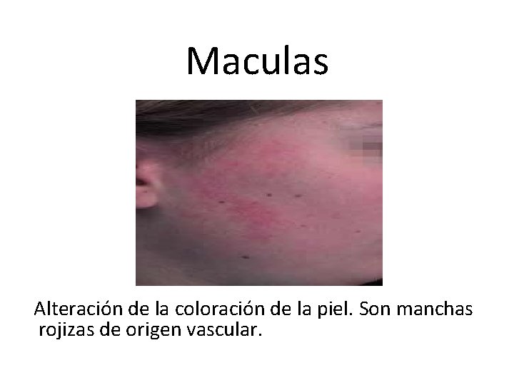 Maculas Alteración de la coloración de la piel. Son manchas rojizas de origen vascular.