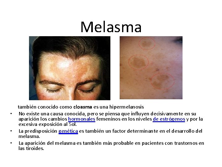 Melasma también conocido como cloasma es una hipermelanosis • No existe una causa conocida,