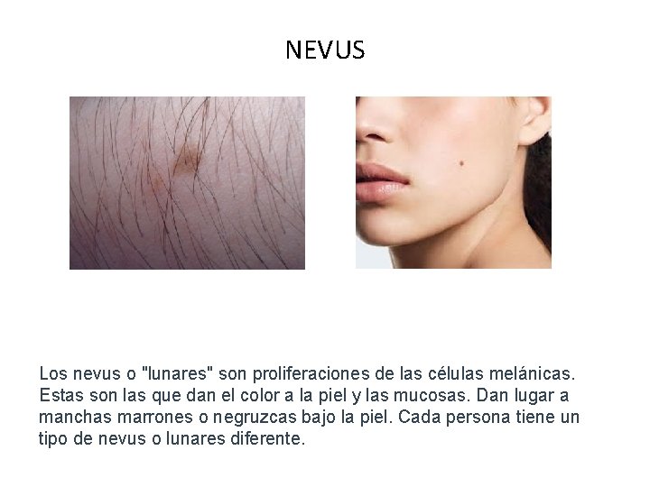 NEVUS Los nevus o "lunares" son proliferaciones de las células melánicas. Estas son las