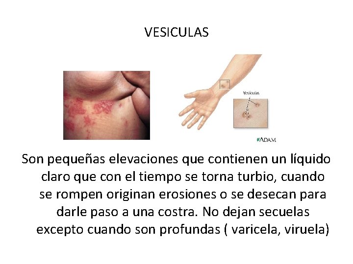 VESICULAS Son pequeñas elevaciones que contienen un líquido claro que con el tiempo se