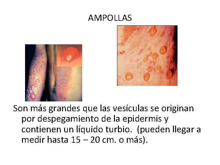 AMPOLLAS Son más grandes que las vesículas se originan por despegamiento de la epidermis