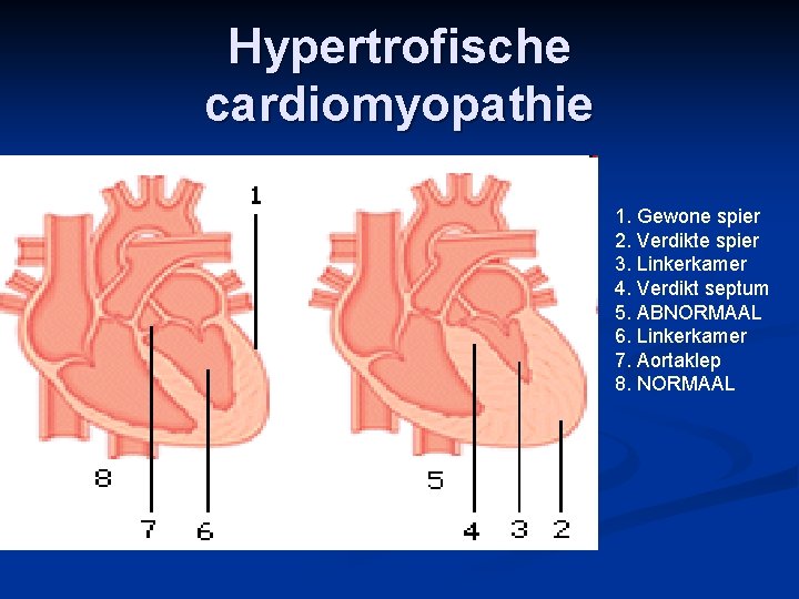 Hypertrofische cardiomyopathie 1. Gewone spier 2. Verdikte spier 3. Linkerkamer 4. Verdikt septum 5.