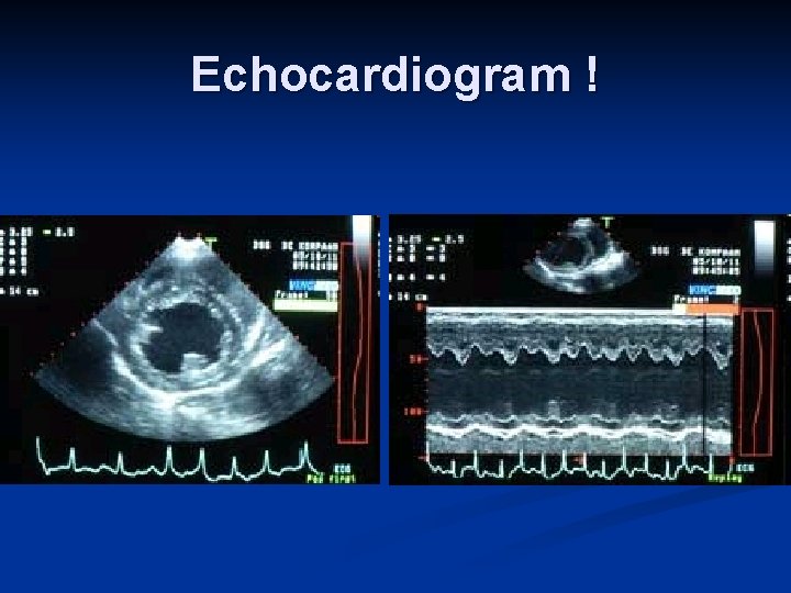 Echocardiogram ! 