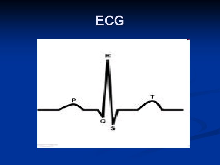 ECG 