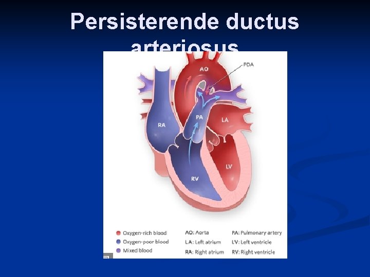 Persisterende ductus arteriosus 