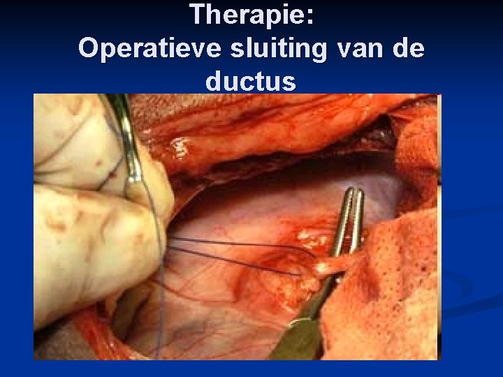 Therapie: Operatieve sluiting van de ductus 