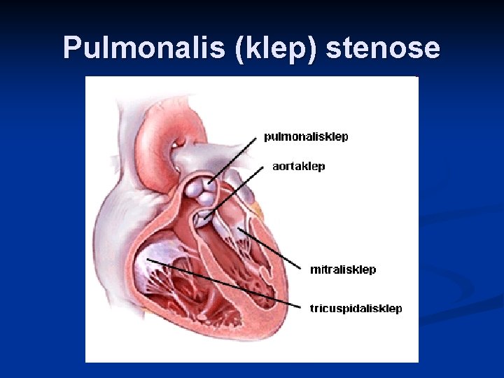 Pulmonalis (klep) stenose 