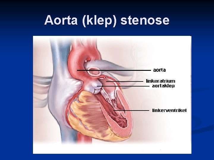 Aorta (klep) stenose 
