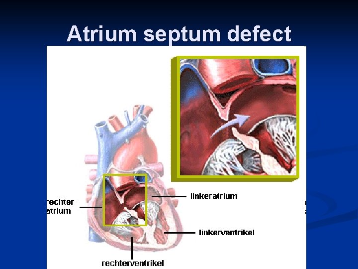 Atrium septum defect 