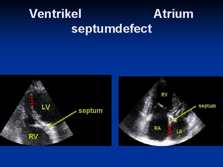 Ventrikel Atrium septumdefect 