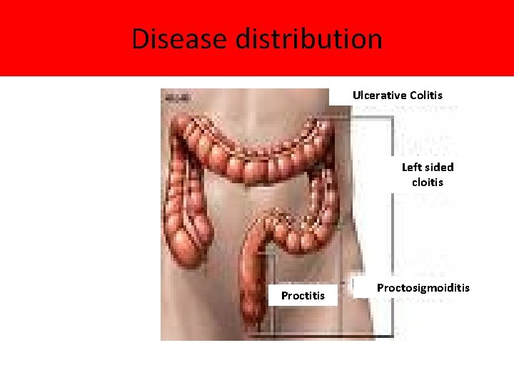 Disease distribution Ulcerative Colitis Left sided cloitis Proctosigmoiditis 