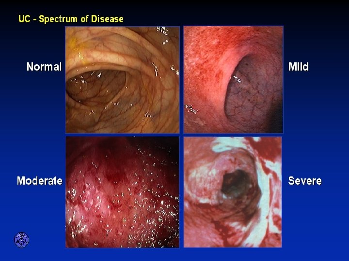 ENDOSCOPIC SPECTRUM OF SEVERITY ENDOSCOPIC SPECTRUM OF SEVERITY