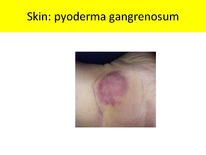 Skin: pyoderma gangrenosum 