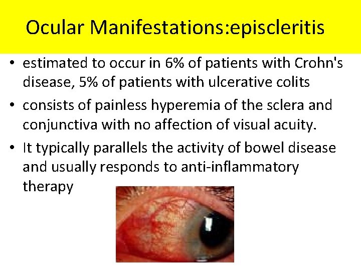 Ocular Manifestations: episcleritis • estimated to occur in 6% of patients with Crohn's disease,