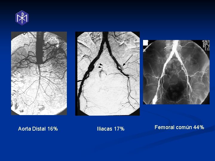 Aorta Distal 16% Iliacas 17% Femoral común 44% 