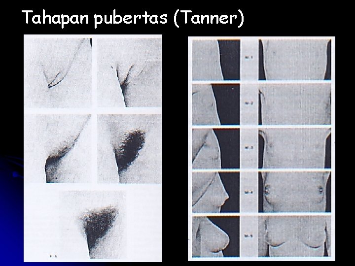 Tahapan pubertas (Tanner) 