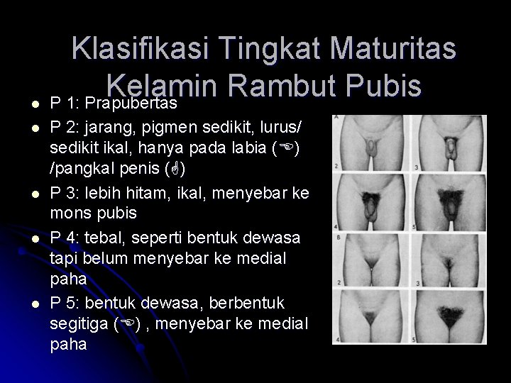 Klasifikasi Tingkat Maturitas Kelamin Rambut Pubis l P 1: Prapubertas l l P 2: