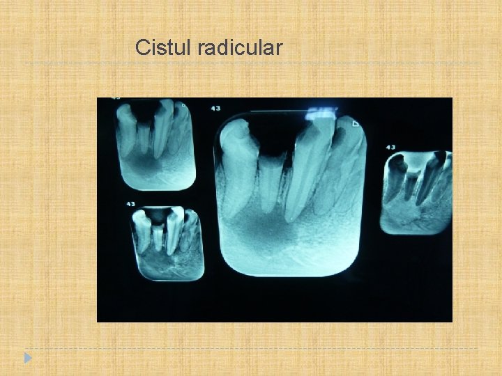  Cistul radicular 