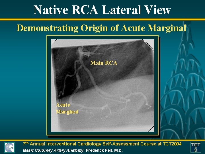 Native RCA Lateral View Demonstrating Origin of Acute Marginal Main RCA Acute Marginal 7