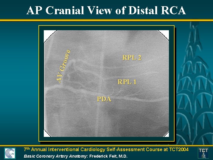 AV Gro ove AP Cranial View of Distal RCA RPL 2 RPL 1 PDA