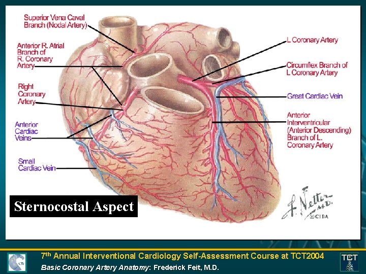 Sternocostal Aspect 7 th Annual Interventional Cardiology Self-Assessment Course at TCT 2004 Basic Coronary
