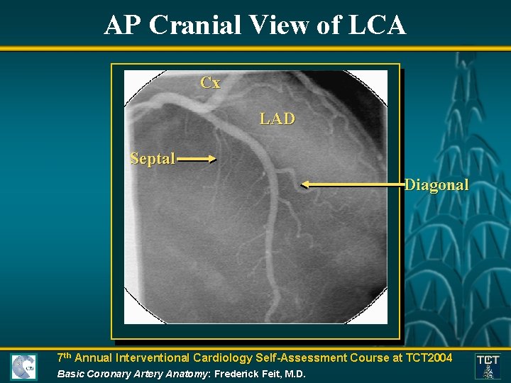 AP Cranial View of LCA Cx LAD Septal Diagonal 7 th Annual Interventional Cardiology