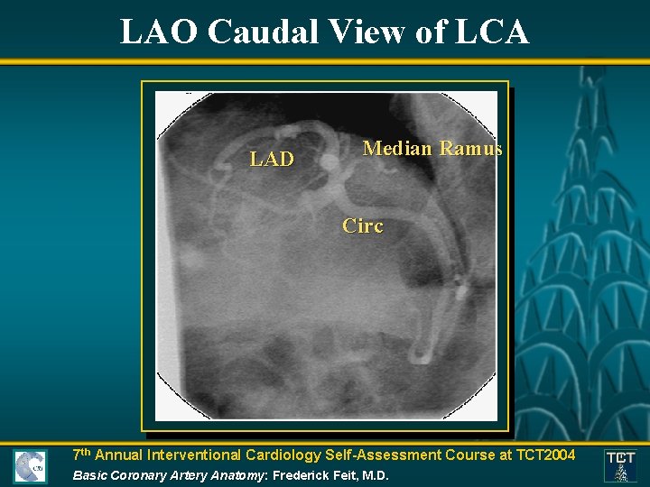 LAO Caudal View of LCA LAD Median Ramus Circ 7 th Annual Interventional Cardiology