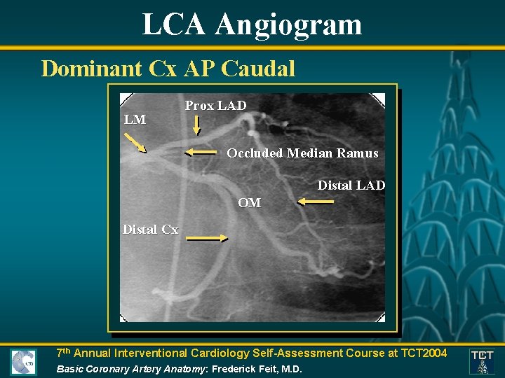 LCA Angiogram Dominant Cx AP Caudal LM Prox LAD Occluded Median Ramus Distal LAD