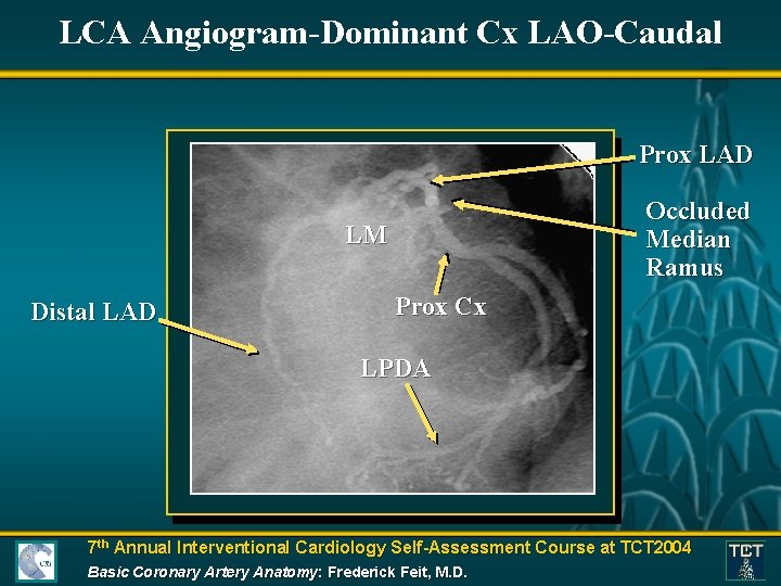 LCA Angiogram-Dominant Cx LAO-Caudal Prox LAD Occluded Median Ramus LM Distal LAD Prox Cx