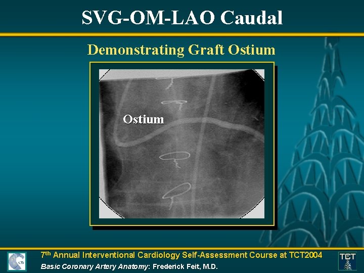 SVG-OM-LAO Caudal Demonstrating Graft Ostium 7 th Annual Interventional Cardiology Self-Assessment Course at TCT