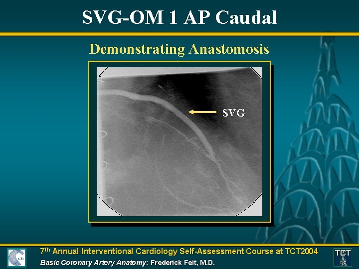 SVG-OM 1 AP Caudal Demonstrating Anastomosis SVG 7 th Annual Interventional Cardiology Self-Assessment Course
